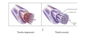 Tendon-normal-y-tendon-degenerado