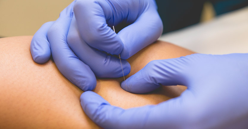 Tratamiento del dolor muscular y fascial mediante punción seca
